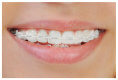 Dental Braces