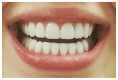 Dental Veneers