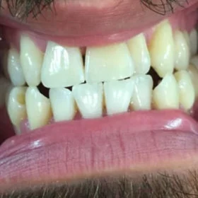 Teeth before