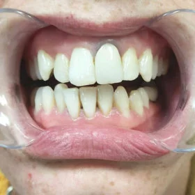 Teeth before